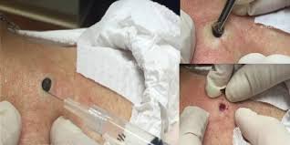 بالفيديو  :  اعتقدت أنها تملك شامة كبيرة.. لكن ما أخرجته الطبيبة كان صادماً!