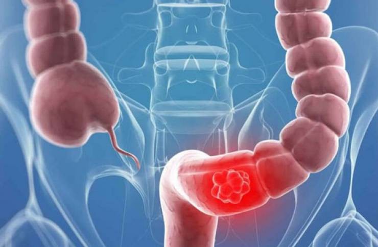 لمرضى القولون العصبي.. لا تقتربوا من هذه الأطعمة!