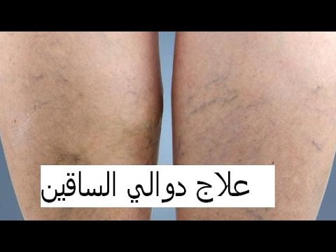 أفضل الطرق المبتكرة لإزالة دوالي الساقين!