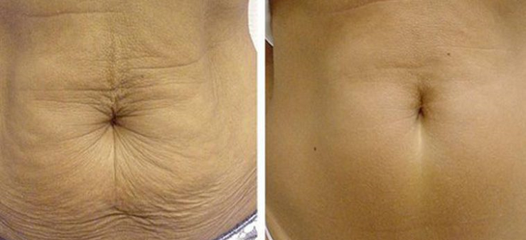 اكتشفي خلطة زيوت طبيعية للتخلص من ترهل الجلد