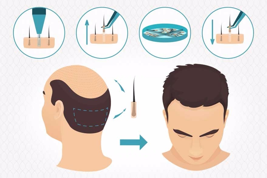 تعرّف على أهم المعلومات بشان عملية زراعة الشعر بتقنية الاقتطاف