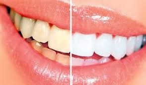 كيف تحمي أسنانك من "لون القهوة"؟