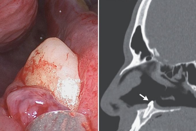 معاناة رجل من أجل التنفس بسبب نمو "سن" داخل أنفه فى حالة نادرة