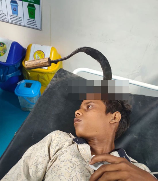 عملية جراحية لاستخراج منجل من رأس مراهق هندى