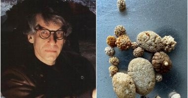 مخرج كندي يعرض صور حصوات كليته في مزاد للبيع