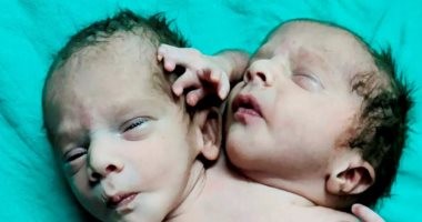ولادة طفل برأسين و3 أيدى وقلبين بالهند