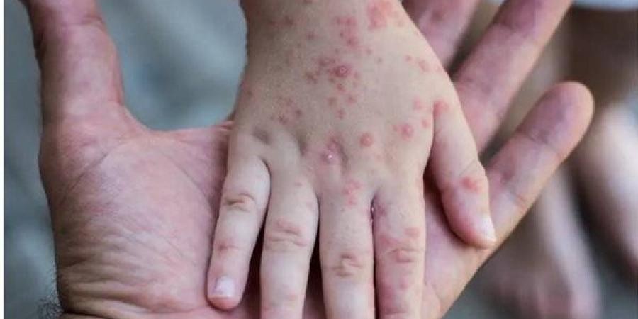 الإعلان عن تسجيل أول إصابة بجدري القرود في السودان