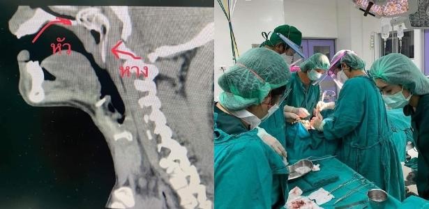 تايلاندى يخضع لعملية جراحية بعد قفز سمكة من الماء إلى حلقه