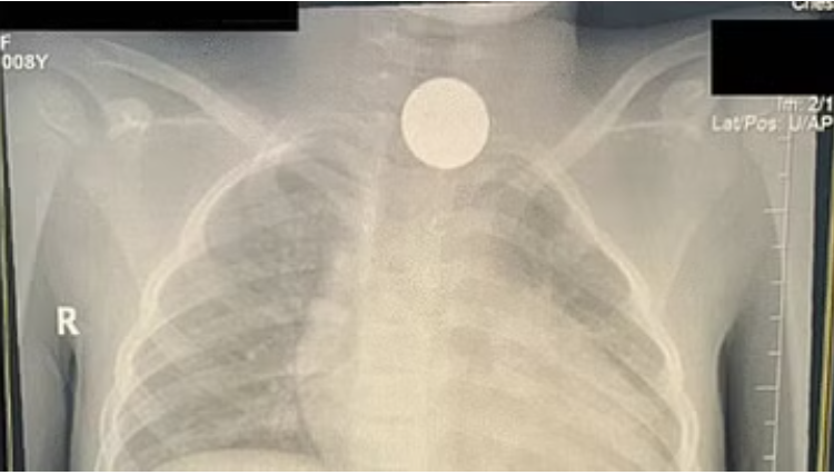 استخراج عملة معدنية من حلق طفلة ظلت عالقة بالمرىء 4 أعوام