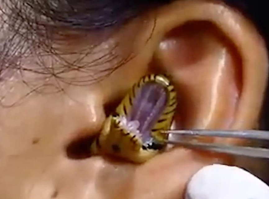 جراح يحاول استخراج ثعبان حى من أذن سيدة فى فيديو صادم