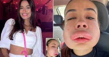 مشهد صادم لإصابة برازيلية بانتفاخ شديد فى وجهها بسبب حشو الفيلر