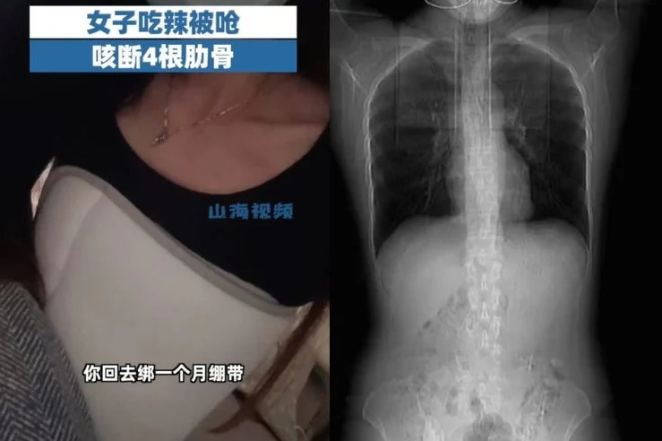 صينية نحيفة تكسر 4 ضلوع أثناء سعالها بعد وجبة طعام حارة