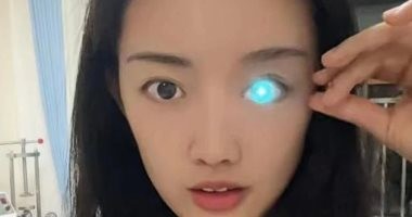 فتاة تتحول إلى أخصائية عيون صناعية بعد 10 سنوات من حادث أفقدها إحدى عينيها