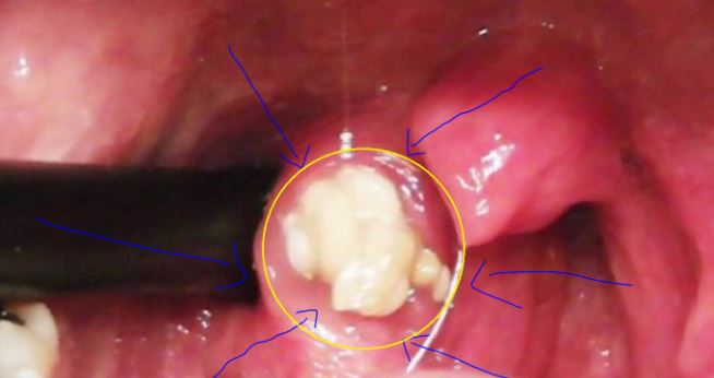 إذا كنت تعاني من رائحة الفم الكريهة فإعلم انك مصاب بهذا المرض!