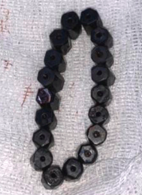 استخراج سوار مغناطيسى من معدة طفل 4 سنوات بعد معاناته من ألم شديد