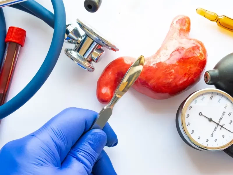 أسباب الوفاة في عملية تكميم المعدة