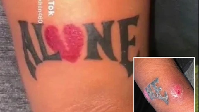 سيدة بريطانية تعانى من تعفن وشم على ذراعها