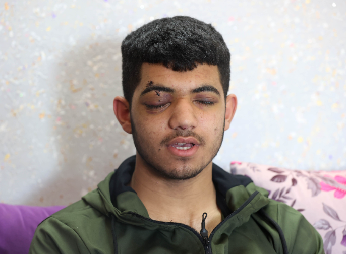 الرئيس عباس يتبنى تكاليف علاج الجريح عمر عاصي من قراوة بني حسان