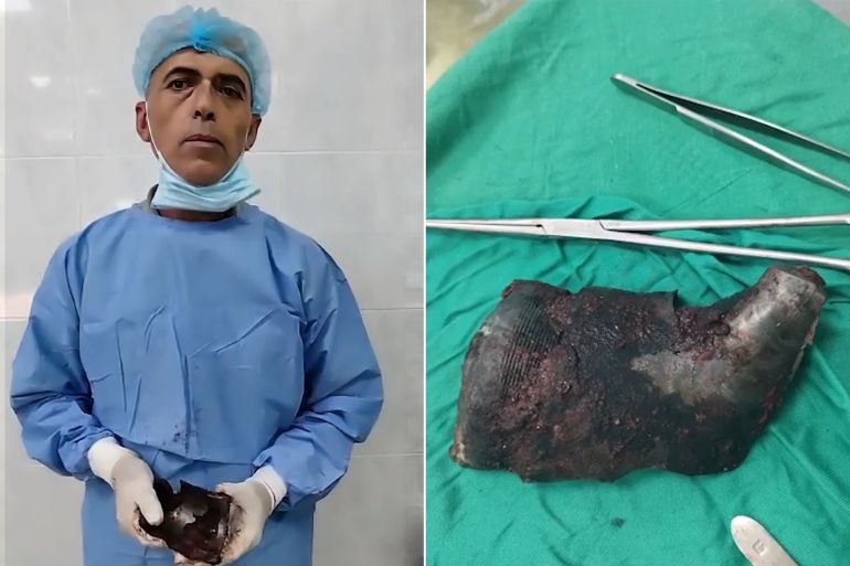 استخراج شظية بوزن كيلو من كتف مصاب في غزة