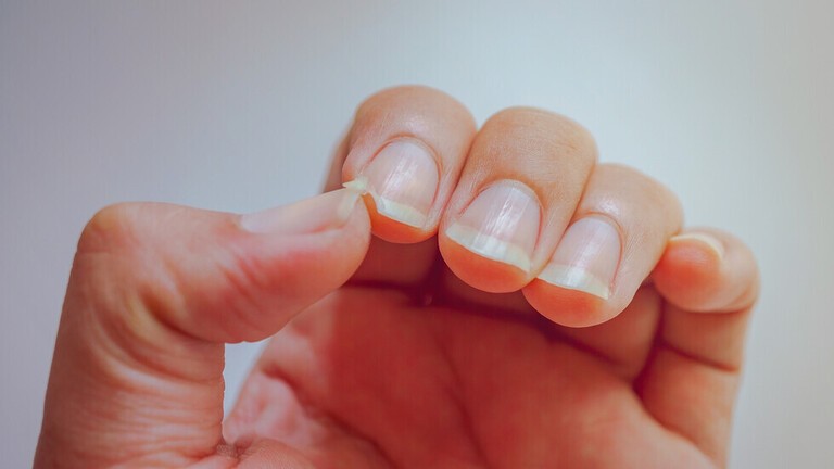 علامة غير معروفة لسرطان "عدواني" تظهر في الأظافر