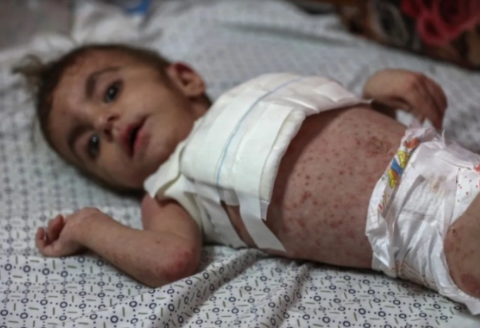 انتشار واسع للأمراض الجلدية في صفوف النازحين بقطاع غزة