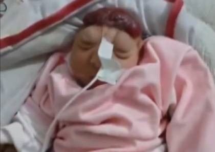 حالة صادمة بغزة.. ولادة طفلة “بلا دماغ” ومطالب بالتحقيق في أسلحة "إسرائيل" (فيديو)
