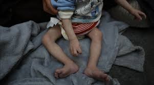 الأمم المتحدة: وفاة أكثر من 100 طفل في غزة بسبب سوء التغذية