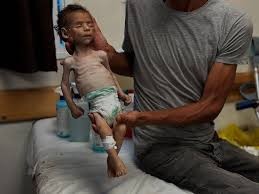 11 وفاة نتيجة المجاعة وسوء التغذية خلال الـ 24 ساعة الماضية