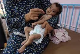 5 وفيات بينها طفلان نتيجة المجاعة وسوء التغذية خلال الـ24 ساعة الماضية