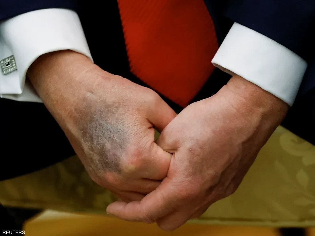 بروز مخاوف صحية جديدة بشأن الرئيس الأمريكي إثر ظهور كدمات زرقاء على يده