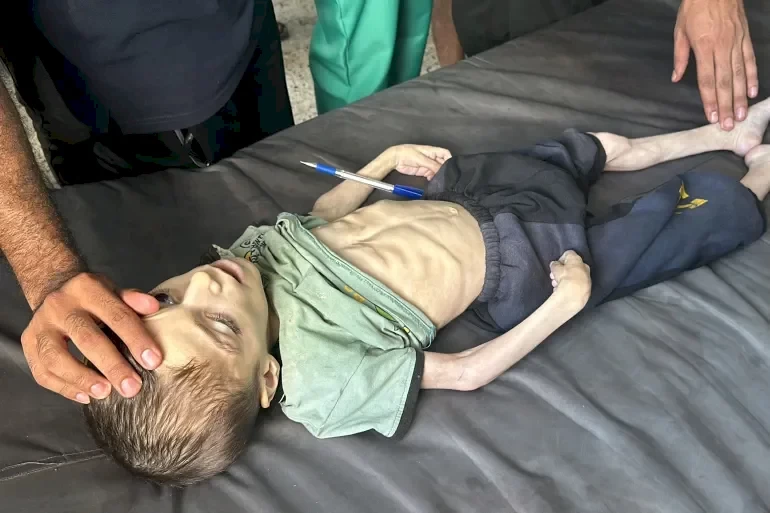 وفاة طفلة بغزة جراء سوء المجاعة وإسرائيل تمنع طبيبين أجنبيين من دخول القطاع