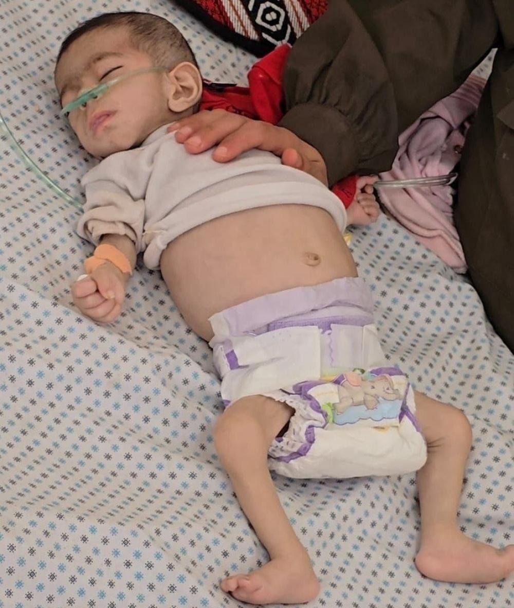 وفاة 3 أطفال إثر سوء التغذية جنوب قطاع غزة