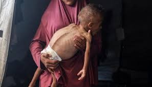 6 وفيات نتيجة التجويع في غزة خلال الساعات الـ24 الماضية