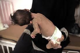 وفاة طفل إثر سوء التغذية بغزة