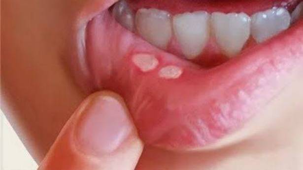وصفة سريعة : 4 طرق طبيعيّة تخلّصك من تقرّحات الفم فوراً