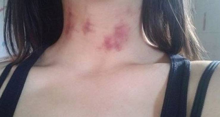 ما لا تعرفه عن البقع الحمراء ما بعد الجماع!