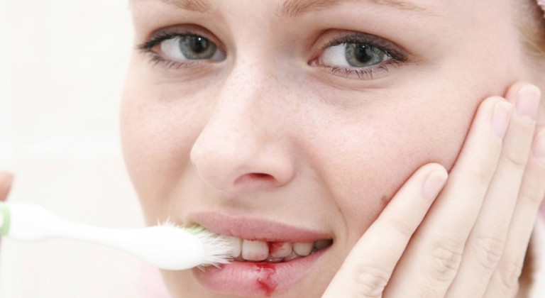 على ماذا يدل نزيف اللثة المتكرر؟