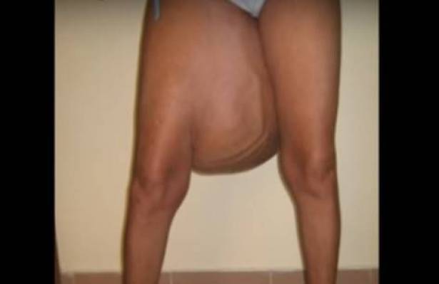 بالفيديو: انتفاخ فخذها أصابها بالرعب.. شاهد ماذا وجدوا داخله؟