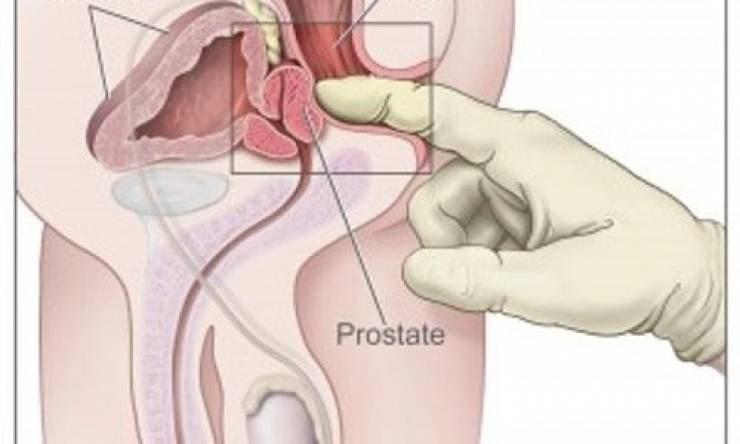 خمس علامات تحذير مبكرة لسرطان الشرج يجب عليك ألا تتجاهلها!