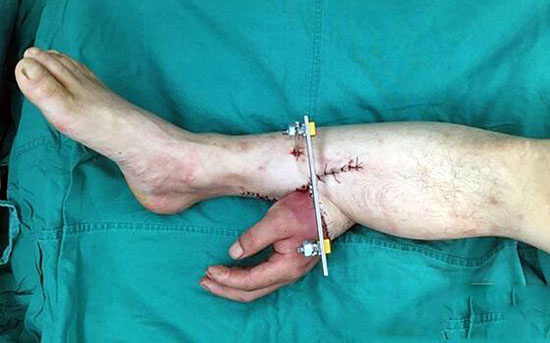 بالصور : أطباء صينيون يرفقون يد عامل بساقه شهرا لإبقائها على قيد الحياة