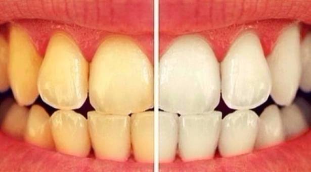 10 أطعمة ومشروبات تؤدي إلى اصفرار أسنانك