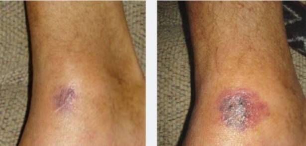 خطيرة جدا : بكتيريا "آكلة اللحوم" تُصيب الآلاف.. إحذروها!