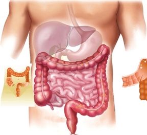 كيف تتفادى سرطان القولون في 9 خطوات!