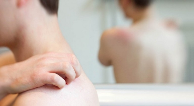 الحزام الناري.. مرض جلدي قد يتحوّل إلى شلل