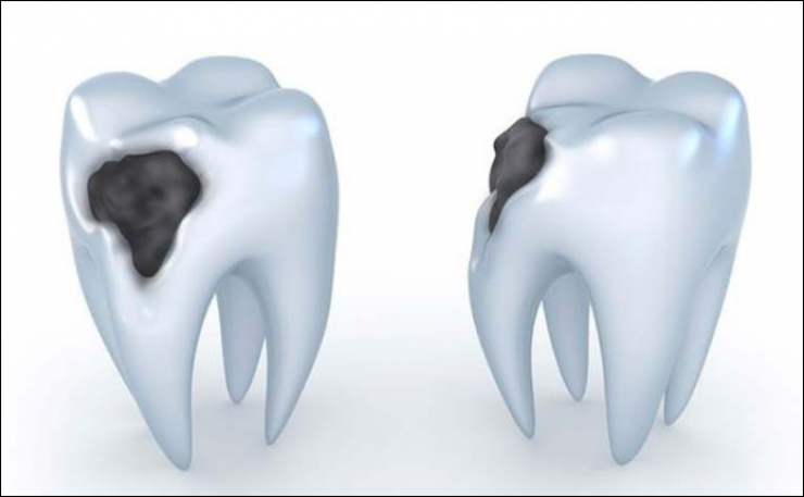 طريقة جديدة تتنبأ بخطر تسوس الأسنان
