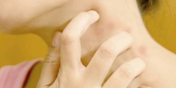 إحذر : إذا احمرّ جلدك وتقشر.. إحذر