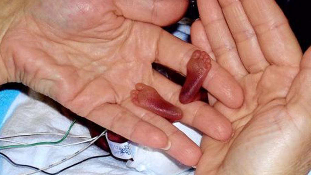 بالصور: الأطباء وصفوها بالمعجزة.. أصغر رضيعة ألمانية في العالم بوزن برتقالة