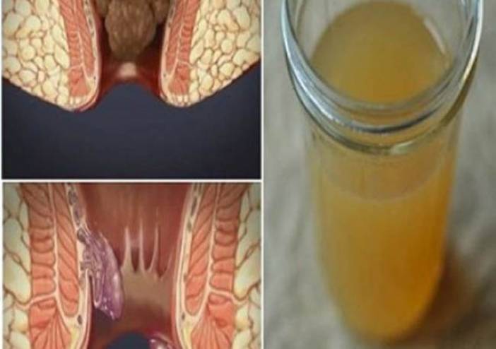 الوصفة الوحيدة التي تزيل البواسير أسرع من أي علاج آخر في 24 ساعة!