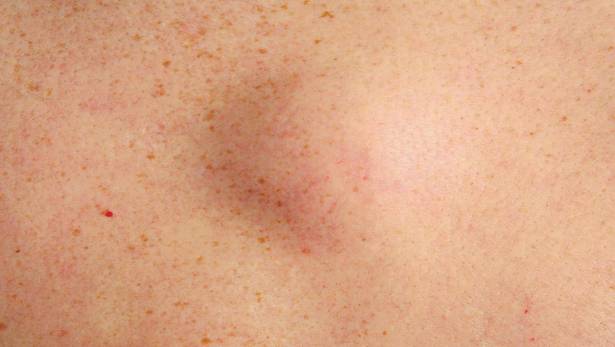 هل تعاني من الأكياس الدهنية؟ إليك هذه الطريقة لعلاجها!