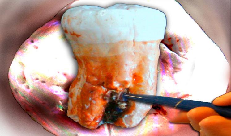 أطباء الأسنان يتعجلون إيقاف التسوس قبل تفاقمه